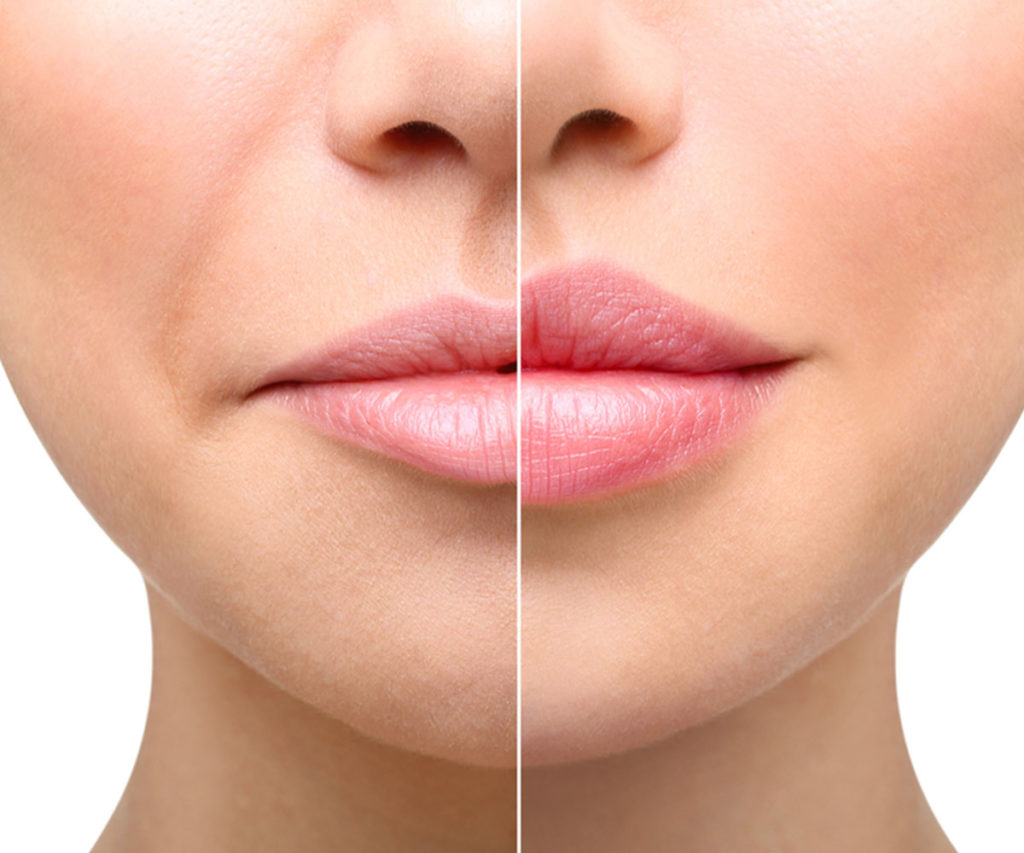 Lip Augmentation