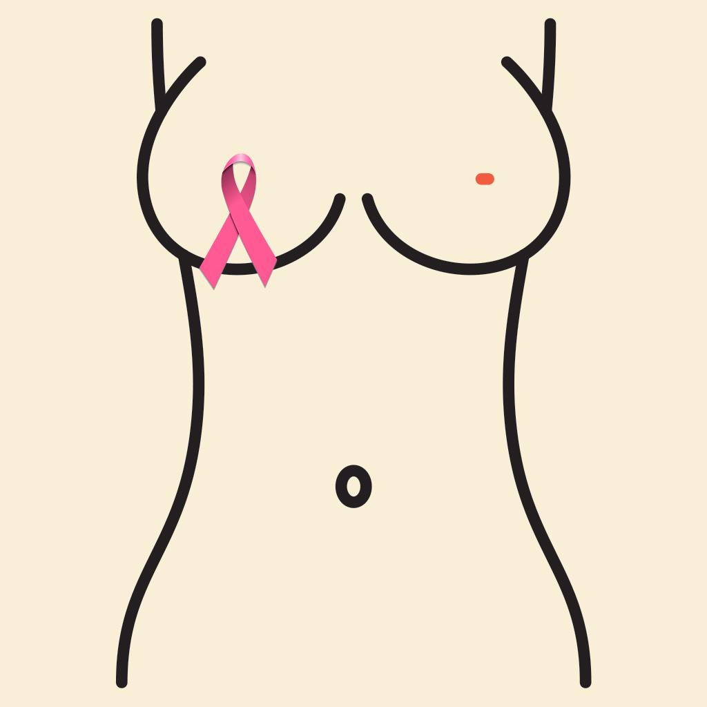 Kanser Sonrası Meme Düzeltme