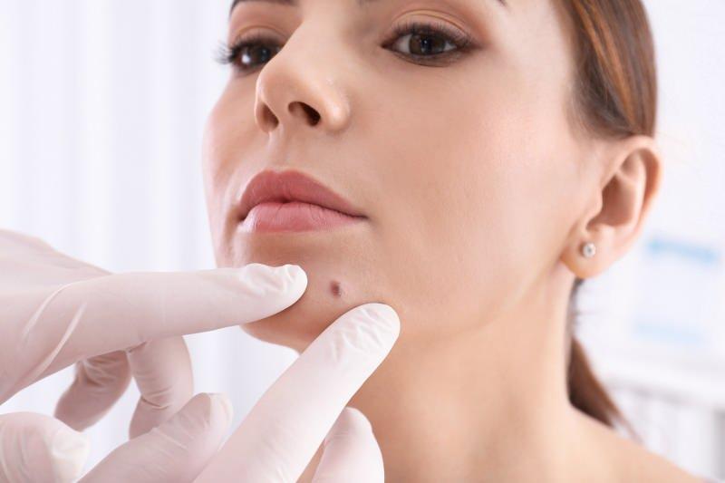 Muttermalentfernung (Nävusexzision)